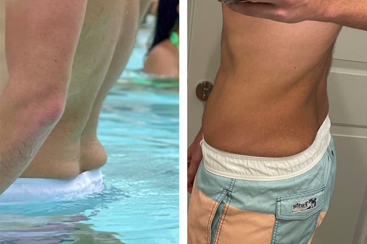 CoolSculpting before and after image