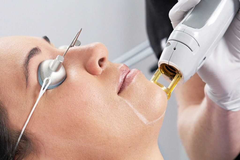 Woman wearing safety protective goggles over eyeballs receiving laser hair removal on a marked off area of her chin